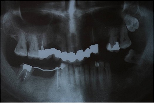 Paziente di anni 65, sesso maschile. Riabilitazione mista impianti denti naturali