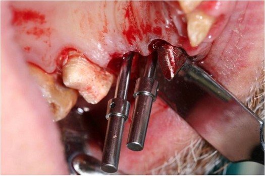 2013 Riabilitazione mista impianti – denti naturali