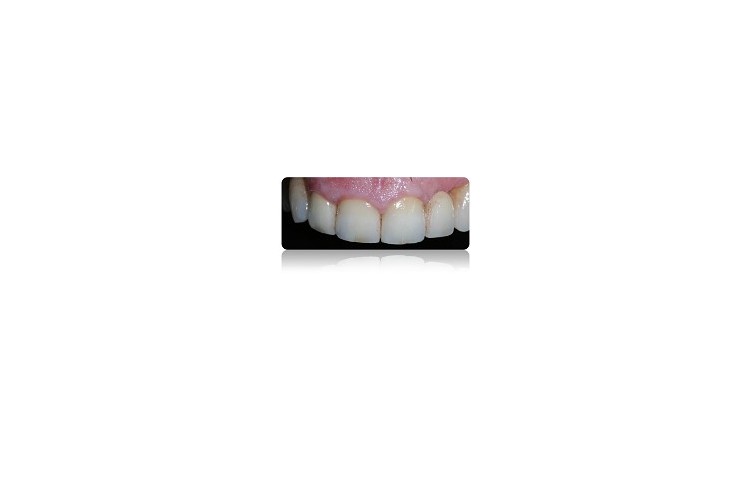 2013 Riabilitazione mista impianti – denti naturali